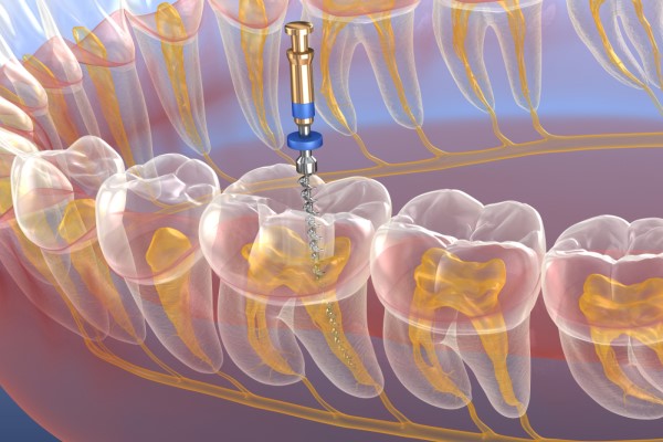 Endodontic Procucts